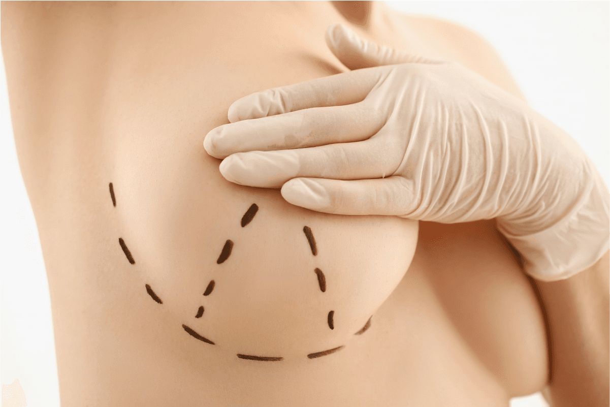 Breast Augmentation
